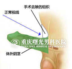 手术去除上方组织