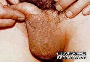 图说阴囊湿疹